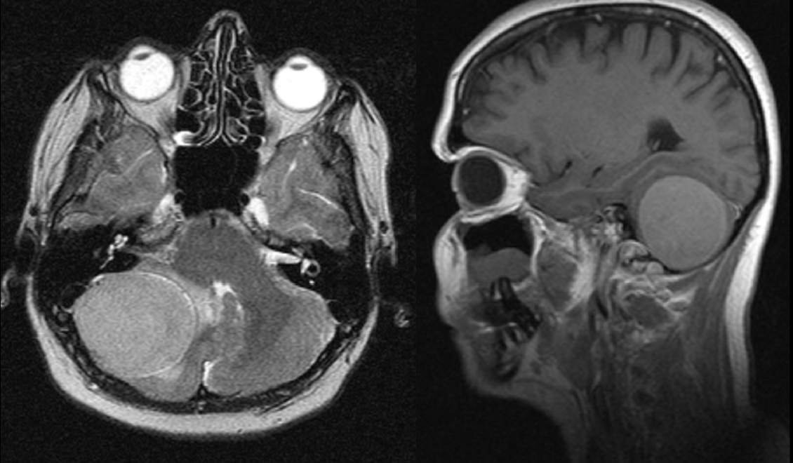 Meningioma fossae cranii post.