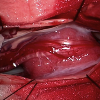 canalis-spinalis-2