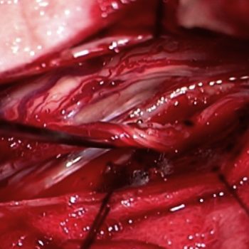 canalis-spinalis-3