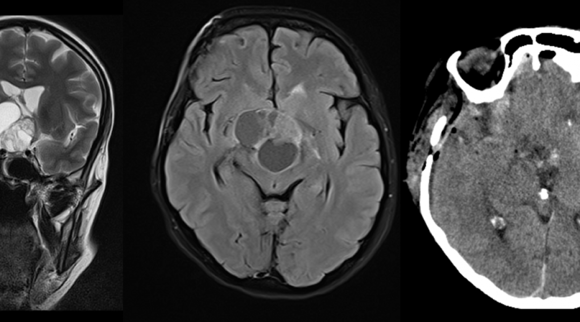 Craniopharyngioma