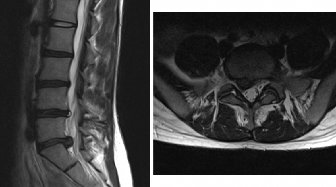 Hernia disci intervertebralis
