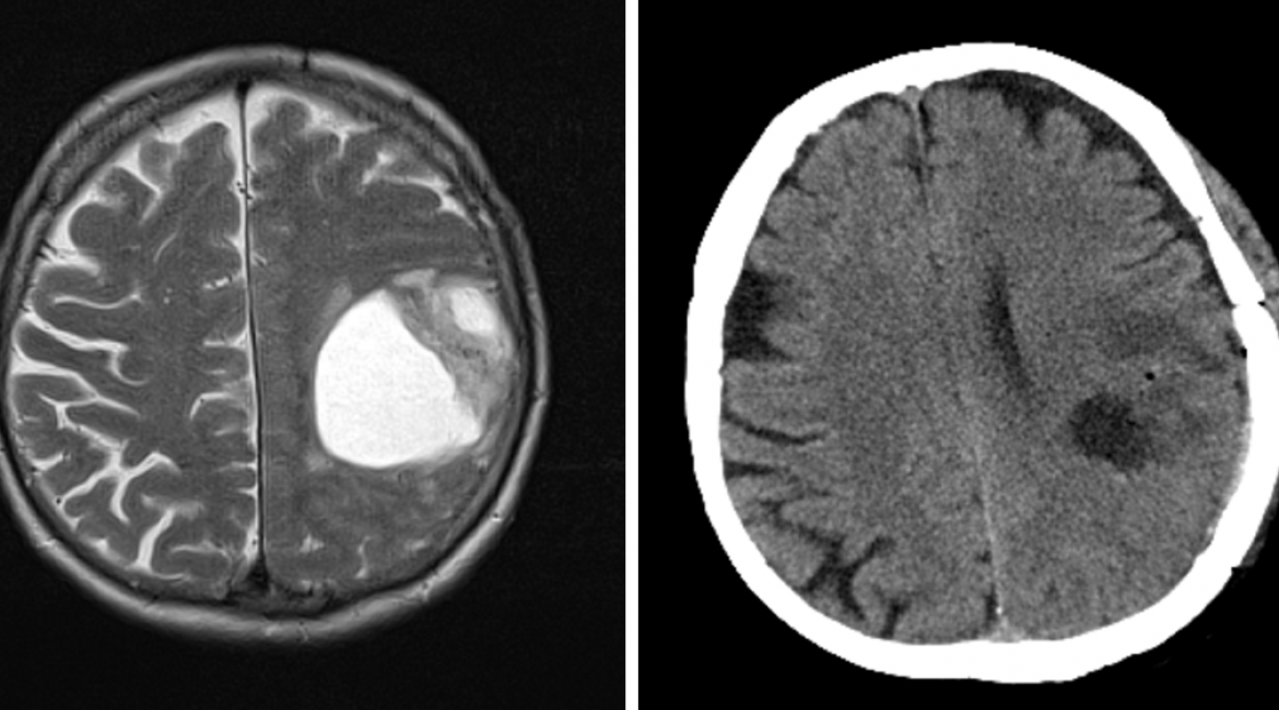 Glioblastoma