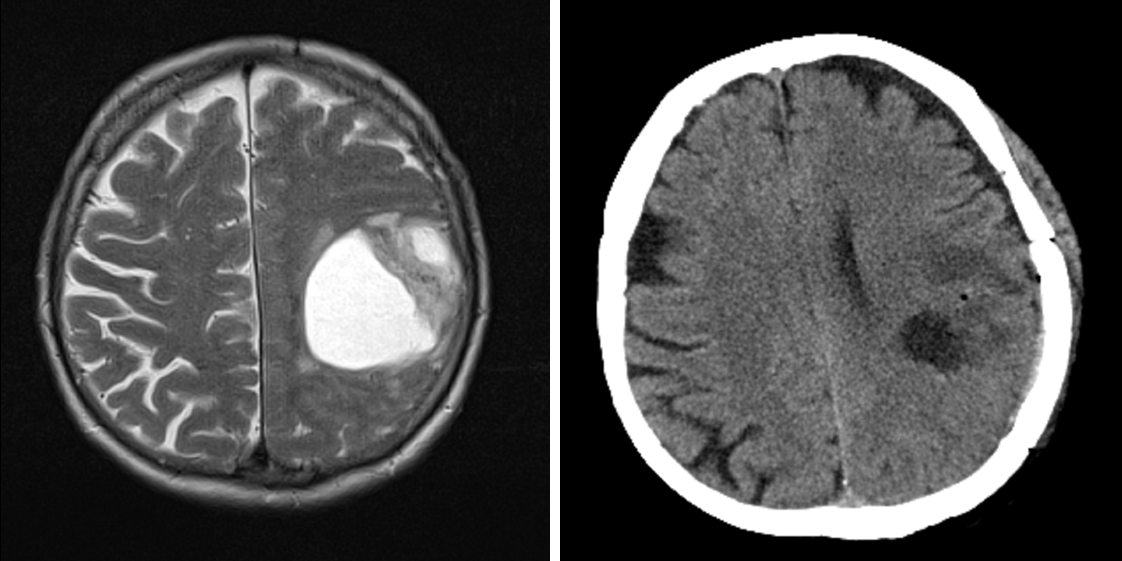 Glioblastoma