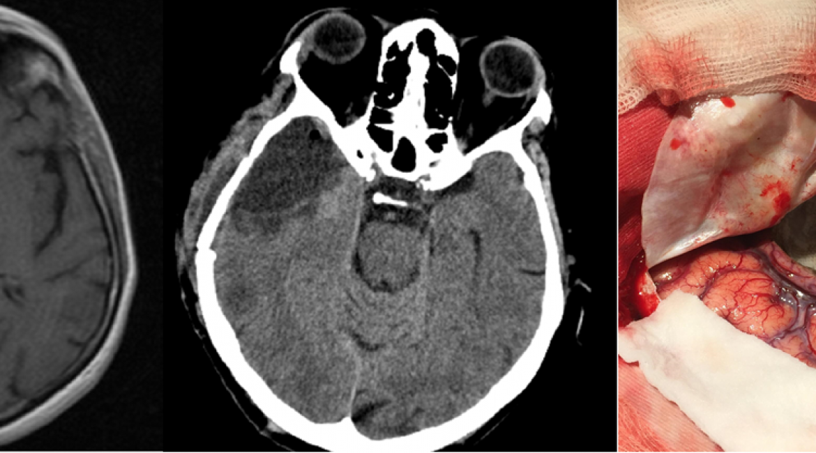 Glioblastoma