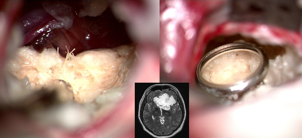 Cholesteatoma