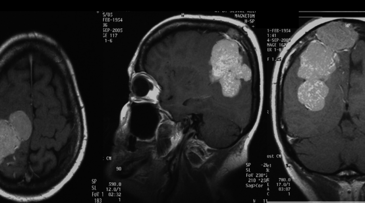 Meningeoma cranii