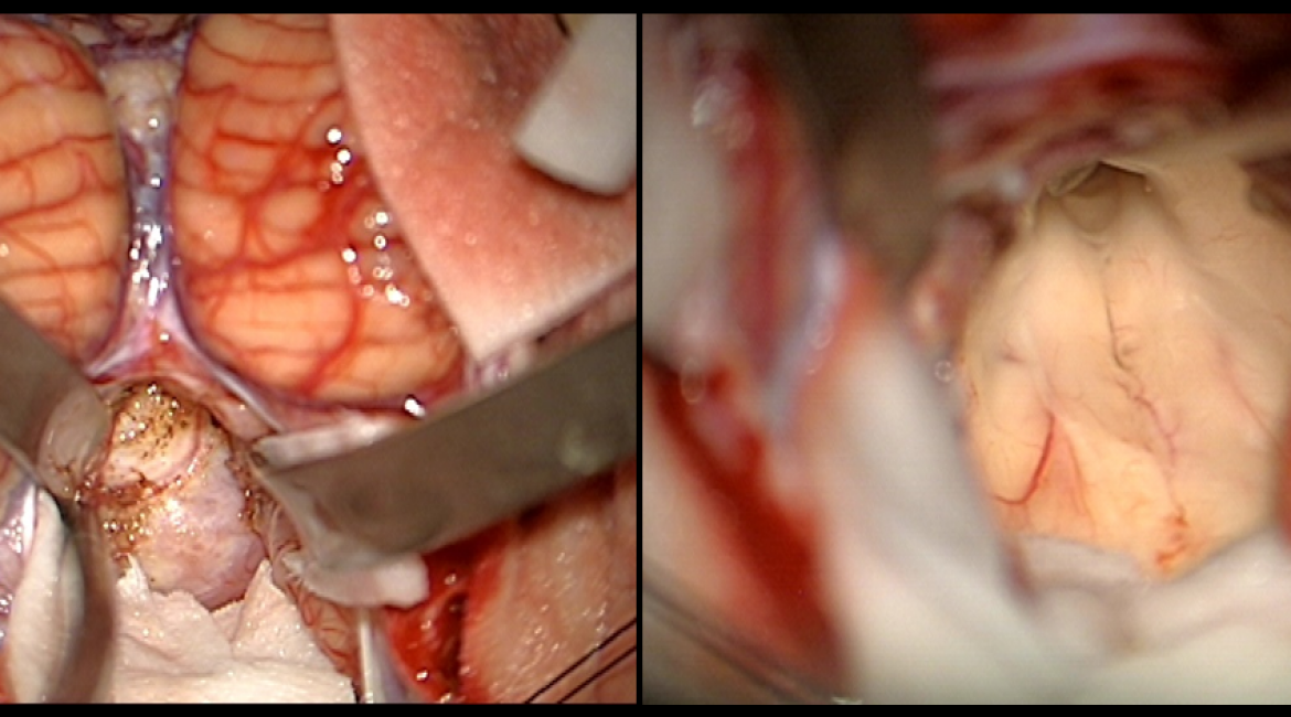 Meningeoma of the IV ventricle – intraoperative