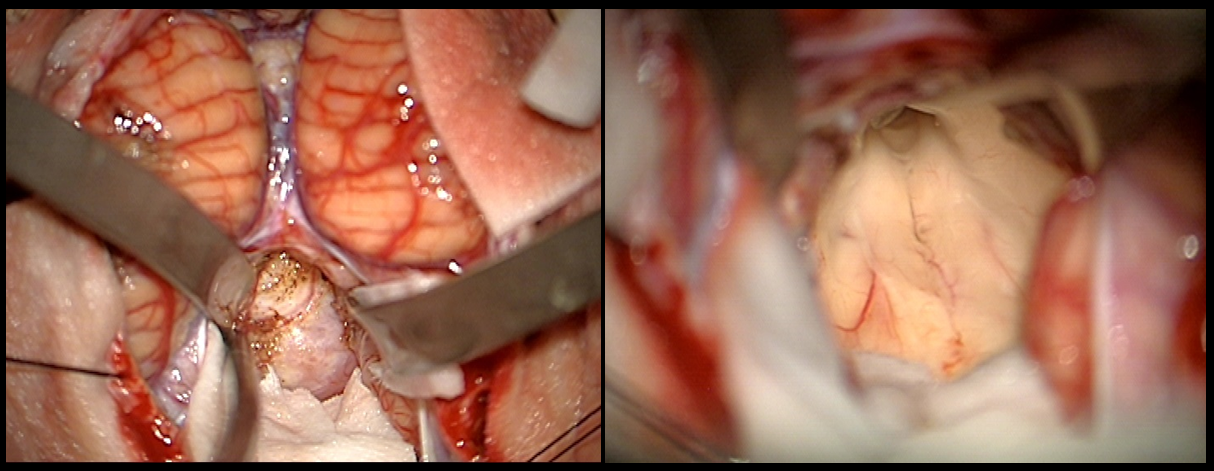 Meningeoma of the IV ventricle – intraoperative