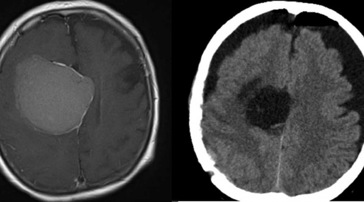 Meningeoma