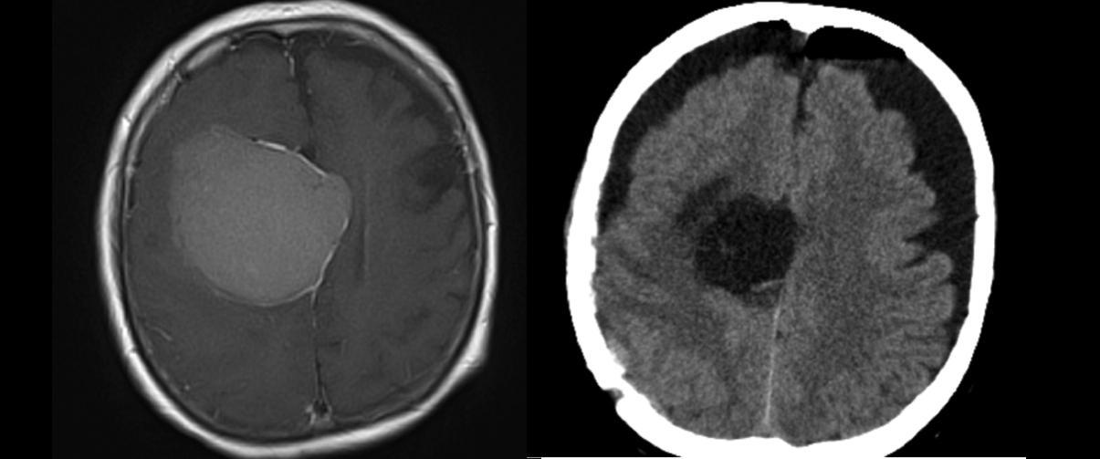Meningeoma