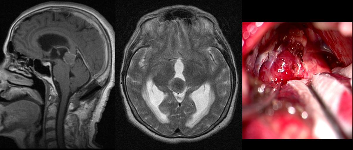 Pinal region tumors