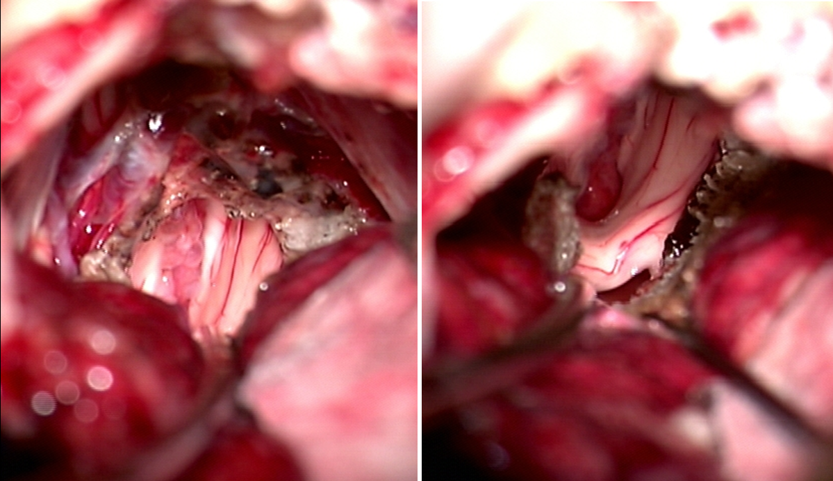 Pinal region tumors II