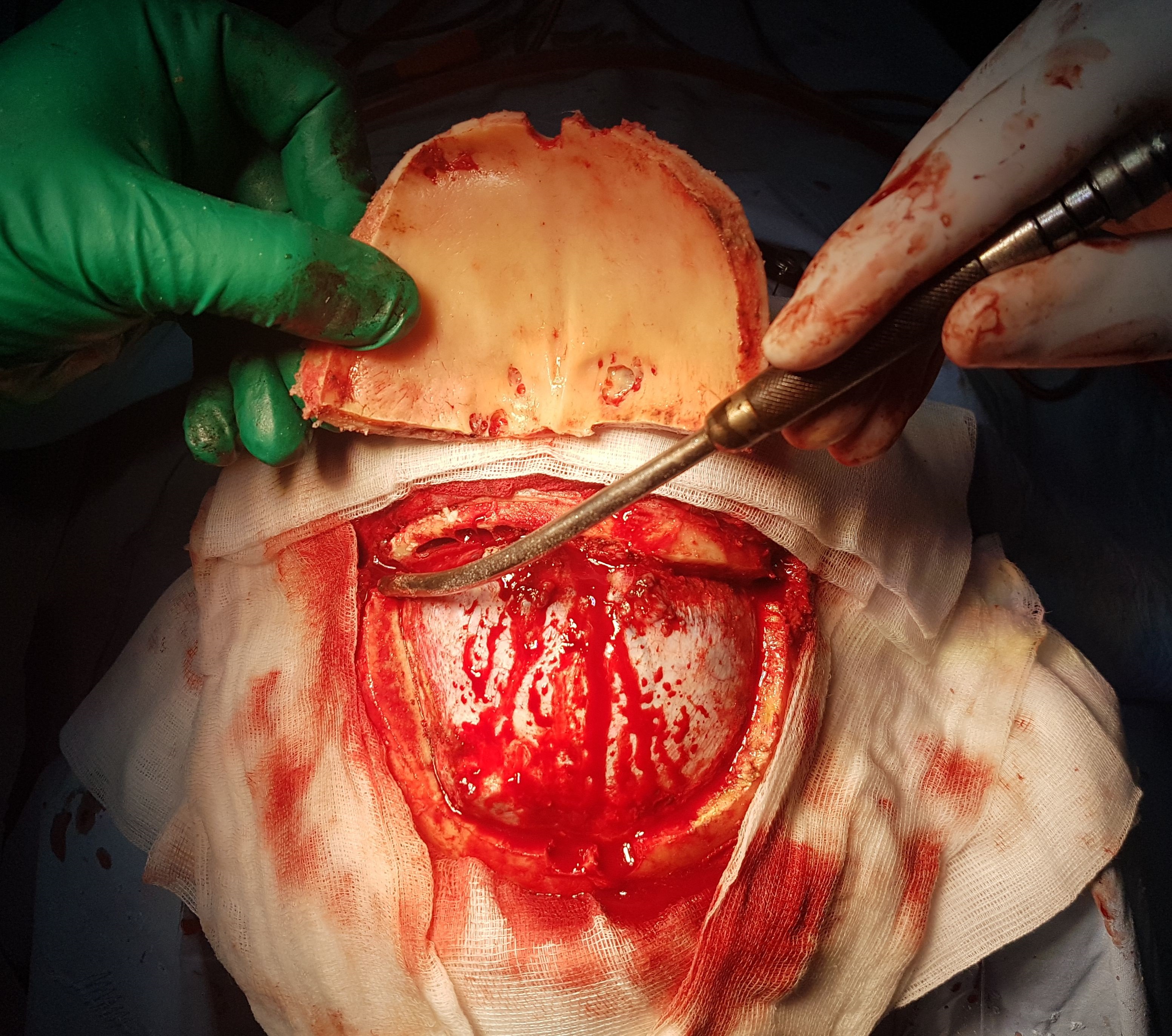 Bifrontal craniotomy