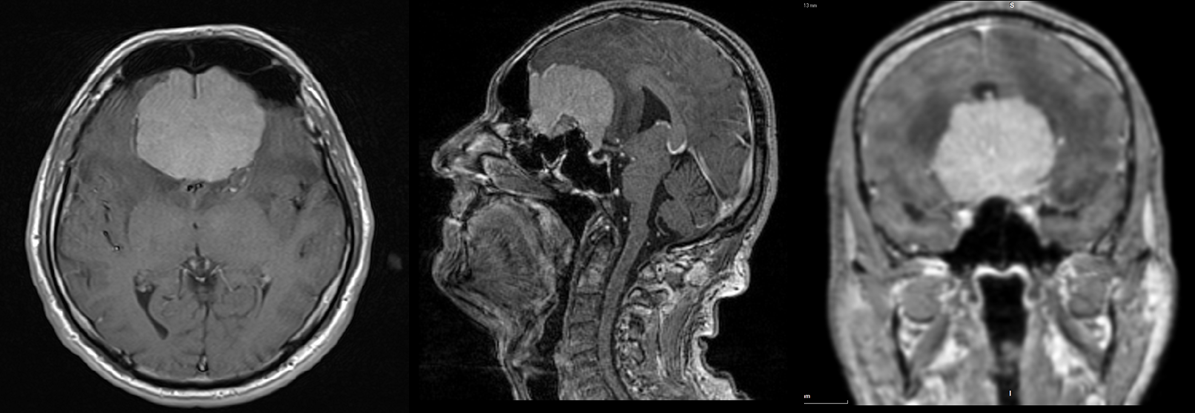 Olfactory meningioma