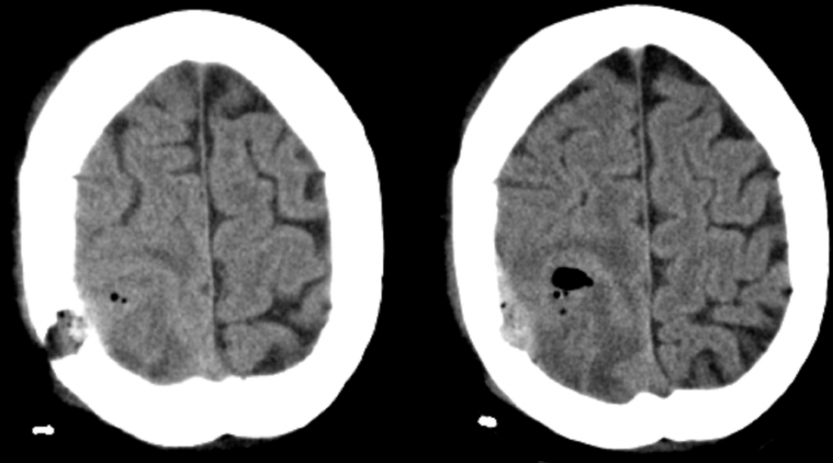 Epidural haematoma: Rare complication after stereotactic evacuation of the intracerebral abscess in patient with Mb. Osler-Weber-Rendu. – preop CT scans