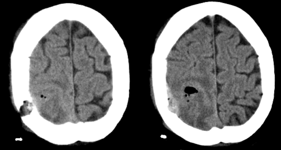 Epidural haematoma: Rare complication after stereotactic evacuation of the intracerebral abscess in patient with Mb. Osler-Weber-Rendu. – preop CT scans
