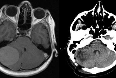 Meningioma fossae cranii post.  – PREOP et POSTOP scans