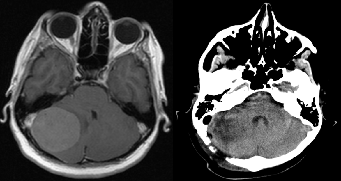 Meningioma fossae cranii post.  – PREOP et POSTOP scans