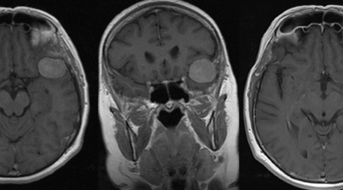 PREOP MR scans and POSTOP MR scan – meningioma.