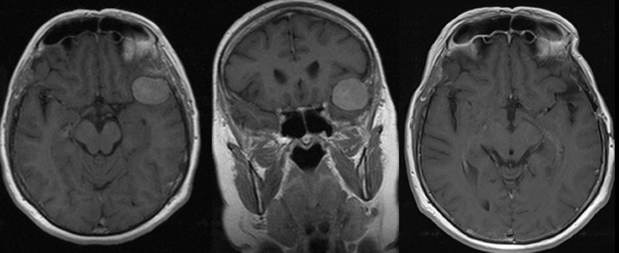 PREOP MR scans and POSTOP MR scan – meningioma.