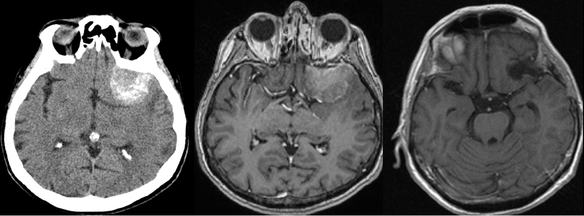 PREOP CT and MR scans and POSTOP MR scan – meningioma.