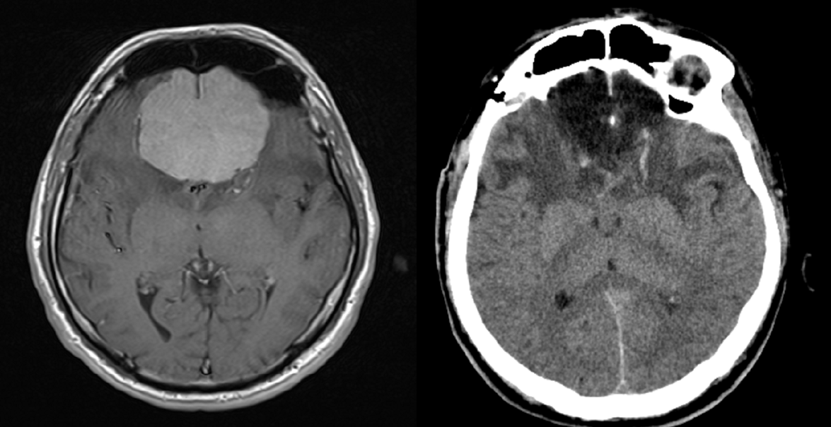Olfactory meningioma-  PREOP et POSTP scans