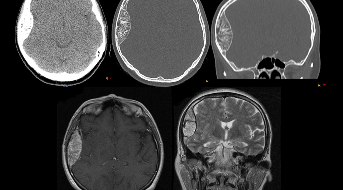 Osseous hemangioma – PREOP CT and MR scans