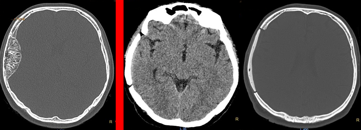 Osseous hemangioma – POSTOP CT scans