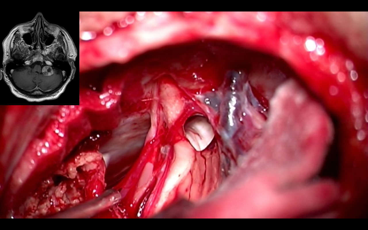 Neurinoma APC – intraoperative findings I