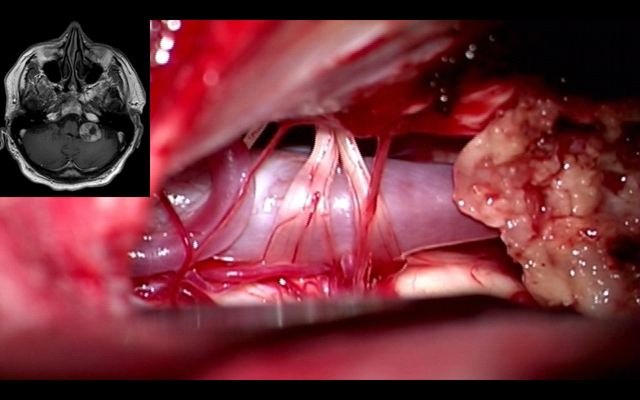 Neurinoma APC – intraoperative findings II