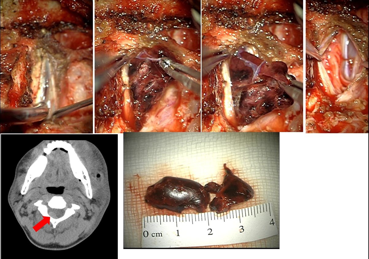 Spinal subdural hematoma – hemilaminectomy CII.